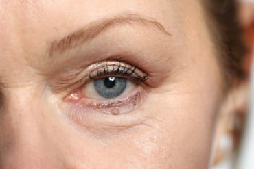 Usuwania zmian z powieki oka – nowoczesne i bezbolesne metody
